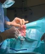 Operacyjne leczenie zeza