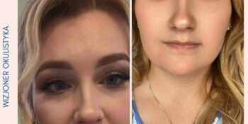 Do czego prowadzi nieleczony zez?